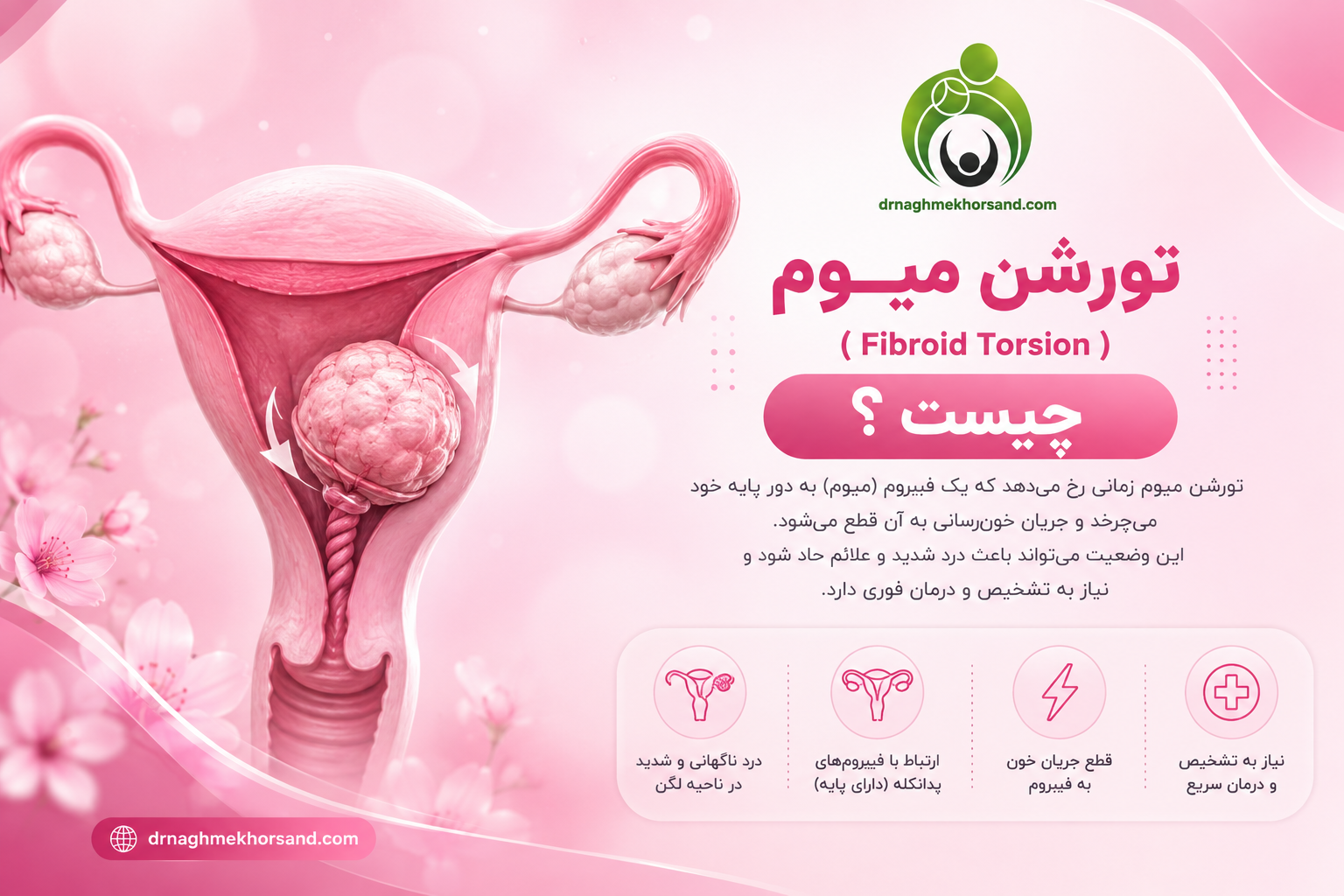 تورشن میوم (Fibroid torsion) چیست؟